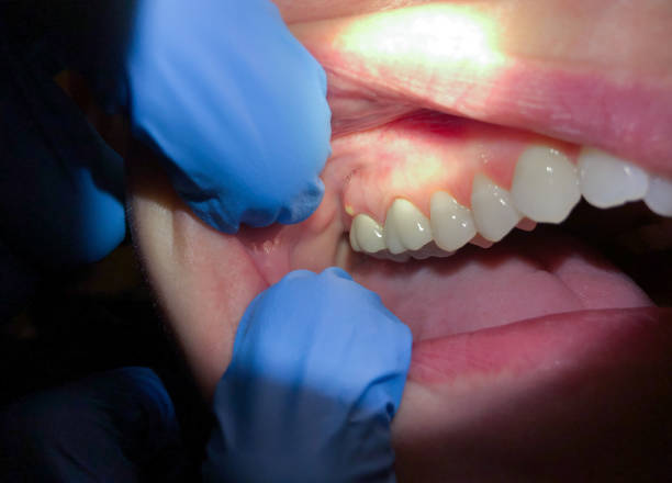 Best Chipped Tooth Repair Near Me  in Allegan, MI